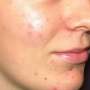 Tratamiento para desvanecer el acne